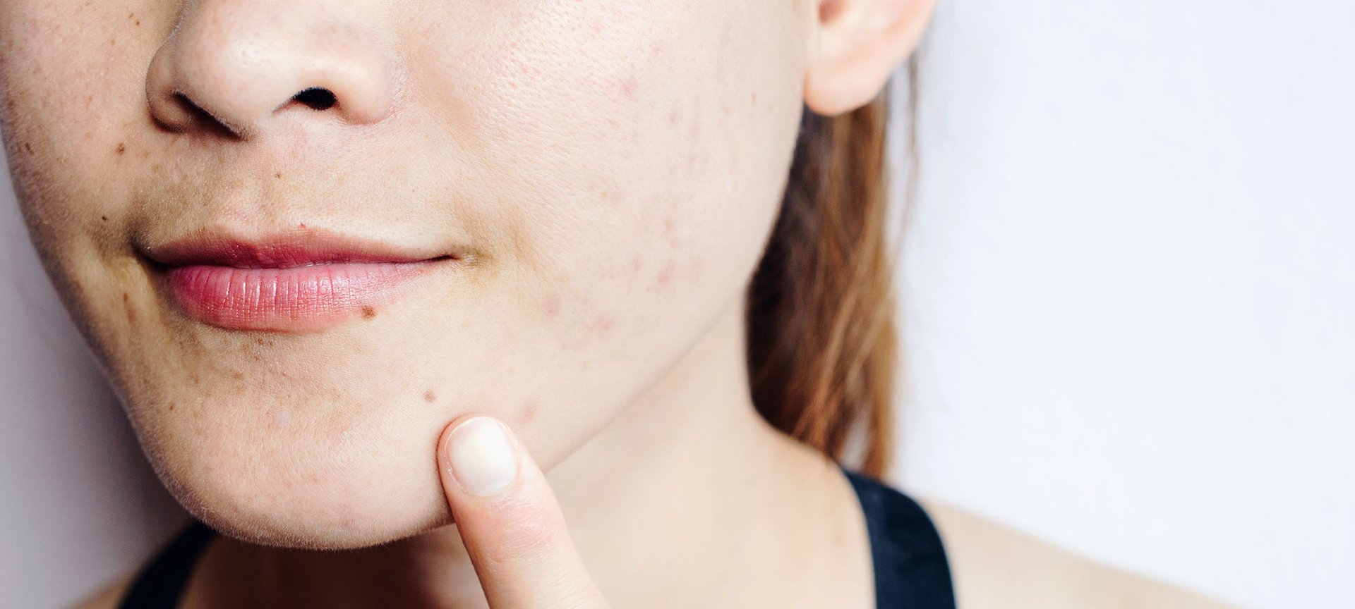 Clogged Pores: What Causes Them and How to UnClog Pores - L'Oréal