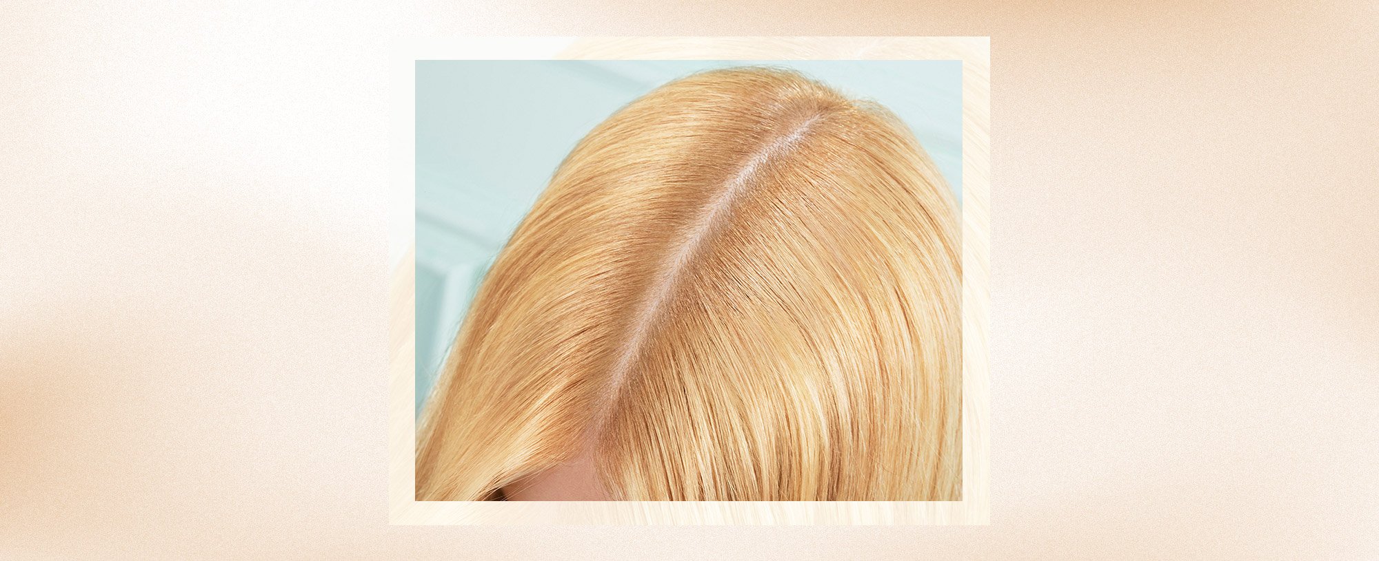 Banner Dandruff Causes And Treatment Tips Desktop